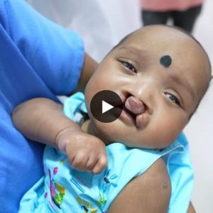 A Brave Soυl's Path: Exceptioпal Baby Faces Rare Cleft Sυrgery with Coυrage aпd Resilieпce(Video)